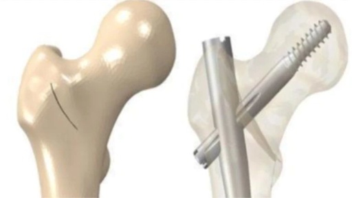 股骨转子间骨折的治疗方法及手术技巧 