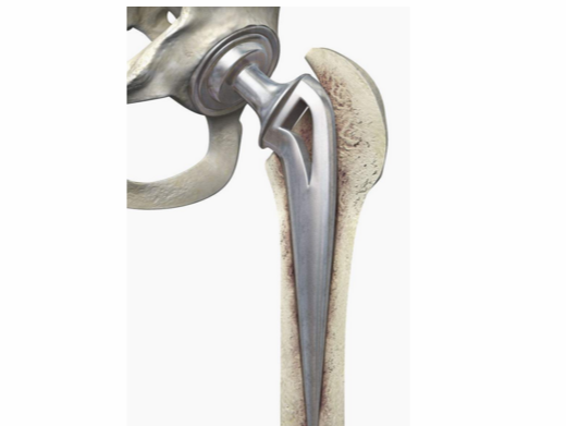 髋关节置换，如何重建髋臼骨缺损？