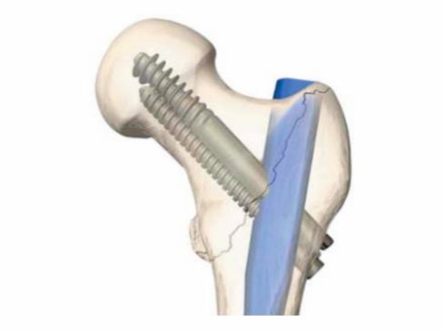 粗隆间骨折复位时，到底足内旋还是外旋？ 