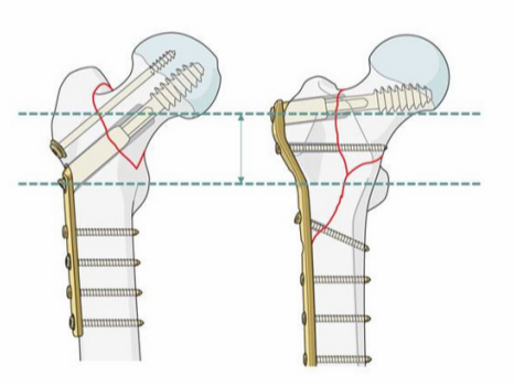 粗隆间骨折失败后，是内固定翻修还是关节置换？