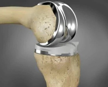 人工膝关节置换技术后常见问题汇总 