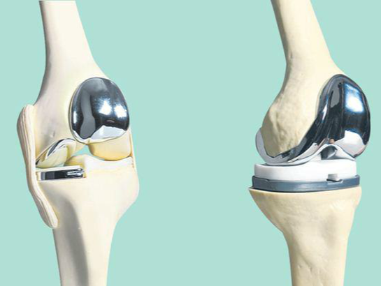 如何做好膝关节置换术中下肢力线与软组织平衡？ 