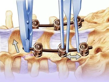 骨科技术：巧拆椎弓根万向钉