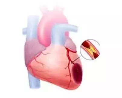 心梗发作的8个典型症状，突发心梗救命的4个要点要记住