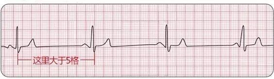 10种异常心电图，这样看秒懂！