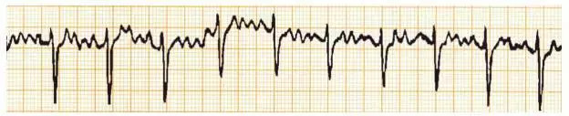 心律失常心电图诊断的10种误诊情况（实例分析）