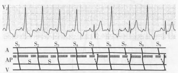 形形色色的心脏电交替现象