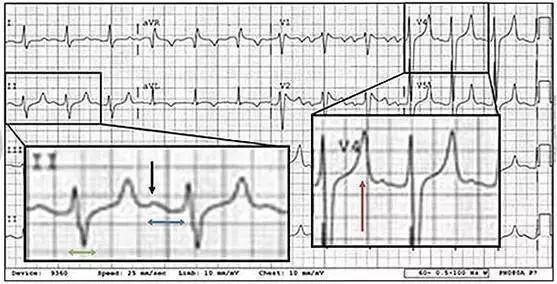 6种可能致命的心电图异常不容忽视