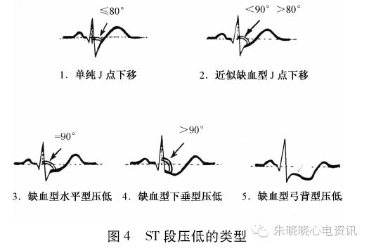 心电图ST-T改变有哪些临床问题，都给你总结好了！