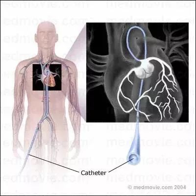 心电图、心超、冠脉造影3种心脏检查，最详细解读！