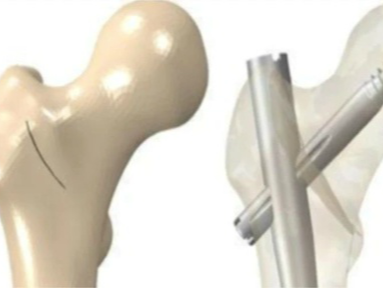 股骨转子下骨折临床诊治策略，详细解析！