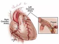 急性心梗时，如何用心电图进行快速定位？