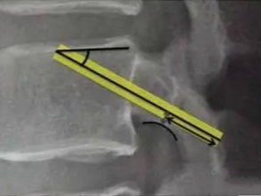 皮质骨螺钉技术及临床应用