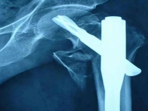 股骨粗隆下骨折髓内钉固定的复位技术