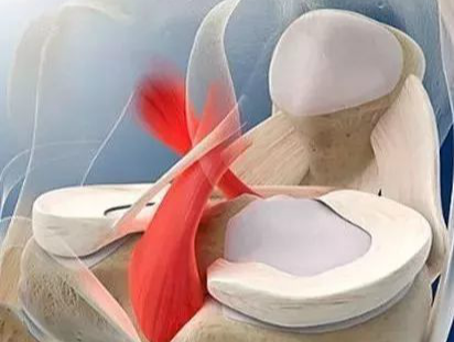 MRI诊断半月板损伤的常见错误