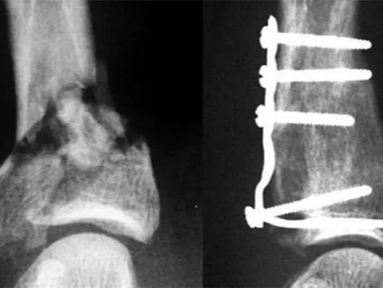 一文理清：Pilon 骨折 3 种手术入路