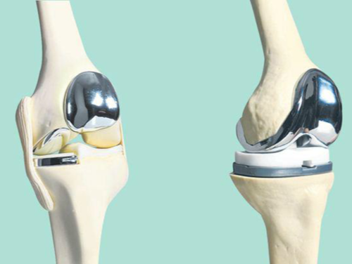 人工全膝关节置换术、单髁置换术、胫骨高位截骨术如何选择
