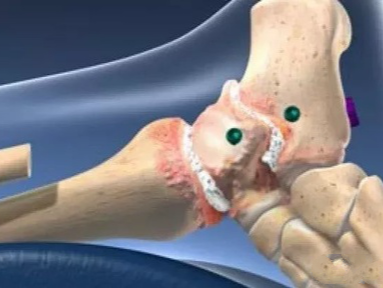 MRI上的踝关节韧带：正常和受伤韧带的外观