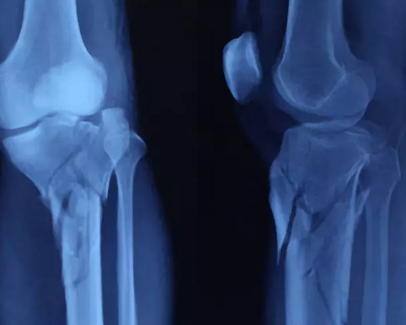 一篇掌握：胫骨近侧干骺端骨折MIPPO技术