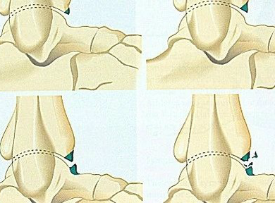 后踝关节撞击综合征如何治疗？这篇给你答案！