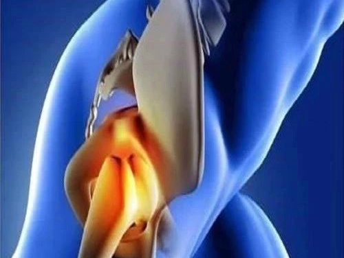 仿生双动髋关节在臀中肌功能不全中的应用