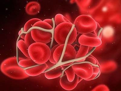 体检血脂正常，为什么血管却堵成这样？