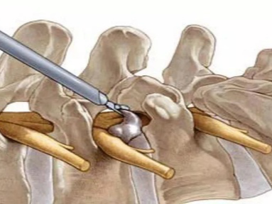 颈椎椎弓根开槽直视置钉技巧