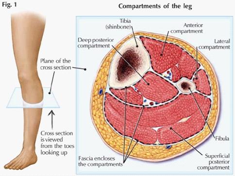 系统详解：小腿骨筋膜室综合征诊治策略