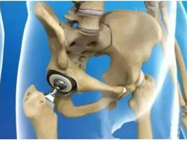 一文详解：髋、膝关节置换围术期TXA应用方案