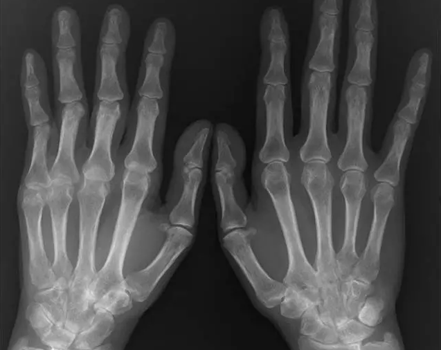 手X线的正常表现、常见变异及病变鉴别