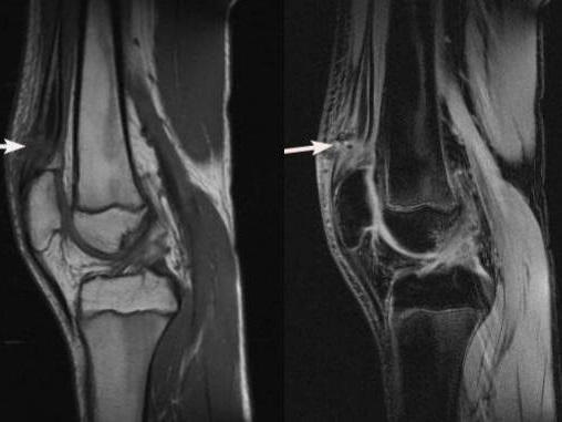 终于整理完了！膝关节各种损伤的MRI表现大集合！