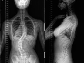 脊柱畸形的X线摄片方法，看完这篇你就掌握！