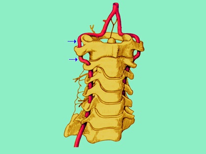 椎动脉：脊柱外科医生最头痛的血管！