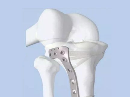 干货分享！脱位型胫骨平台骨折的手术治疗体会