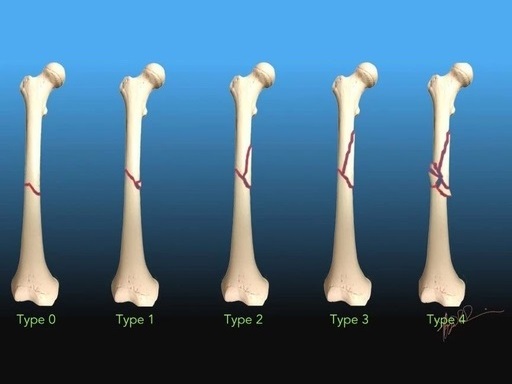 关于股骨干骨折，这5个常见问题你思考过吗？