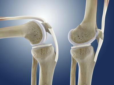 膝骨关节炎阶梯治疗专家共识（2018 年版）