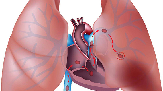 急性肺动脉栓塞和冠心病的鉴别方法