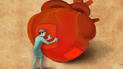 细数急性心梗合并顽固性心衰的N种处理对策