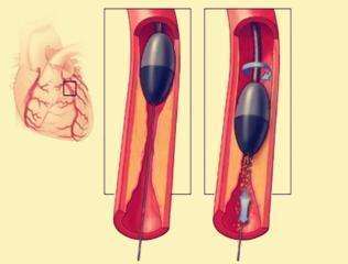 图文并茂：钙化病变利器 —冠脉内旋磨术