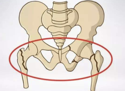 髋部骨折合并同侧股骨干骨折——我猜，你一定不知道！