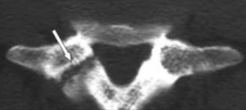 从诊断到治疗：全面解析腰椎峡部裂(lumbar spondylolysis)