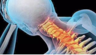 颈痛和颈性头痛，可以通过颈椎手术改善？