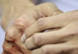 骨科急诊：常见指端损伤处理，详细步骤精讲！