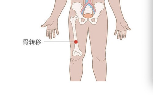 解救深入骨髓的疼痛,骨转移的治疗有哪些选择?