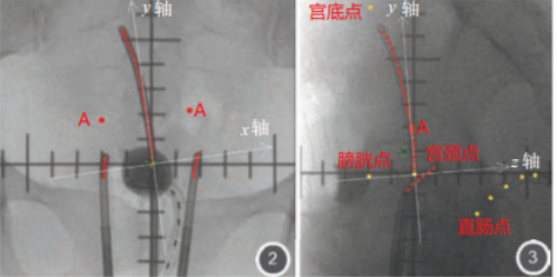 宫颈癌近距离腔内放疗二维治疗技术规范中国专家共识