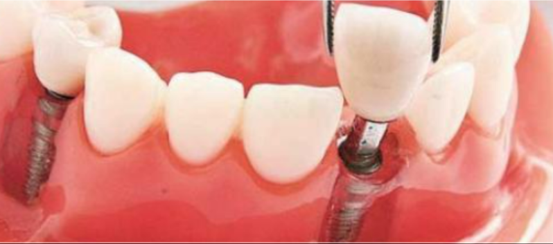 种植牙术后常见并发症的防与治，经典好文推荐！