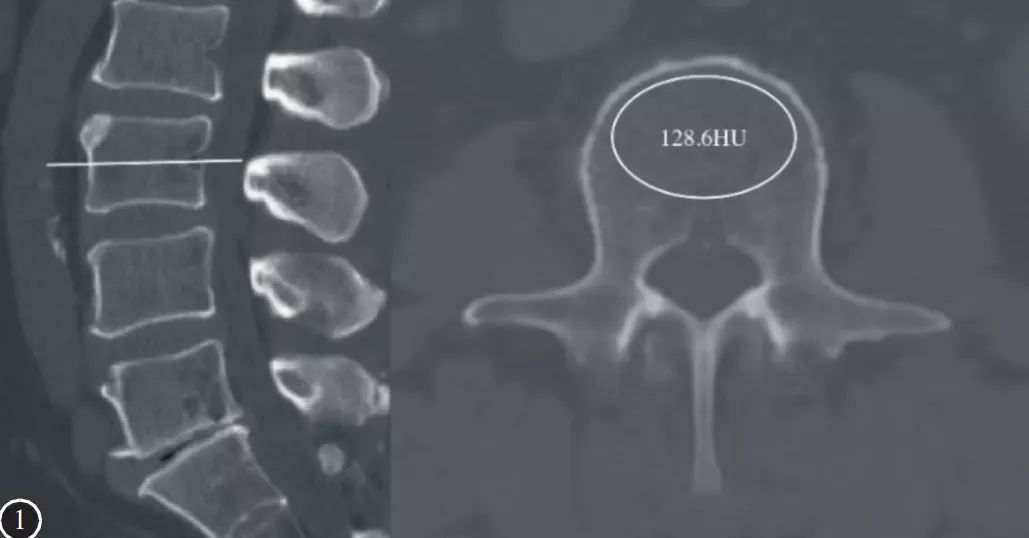 定量CT和椎体松质骨CT值两者你区分清楚了吗？