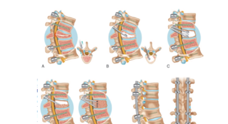 一项治疗Ⅲ期Kummell病的新技术---经椎弓根打压植骨联合后路长节段固定术