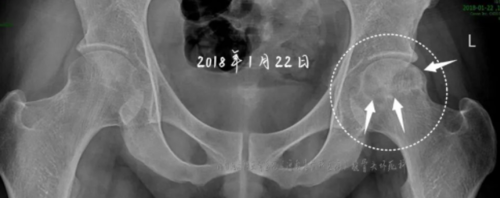 同一病人1、2期股骨头坏死的治疗选择