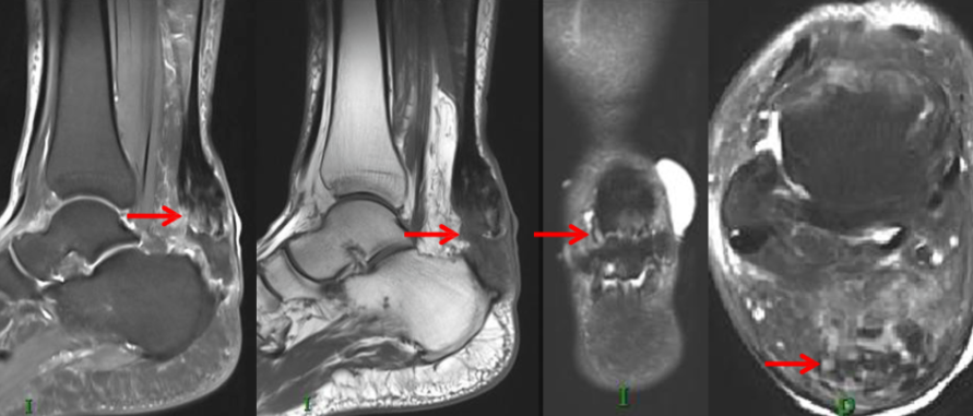 踝关节病变的MRI诊断